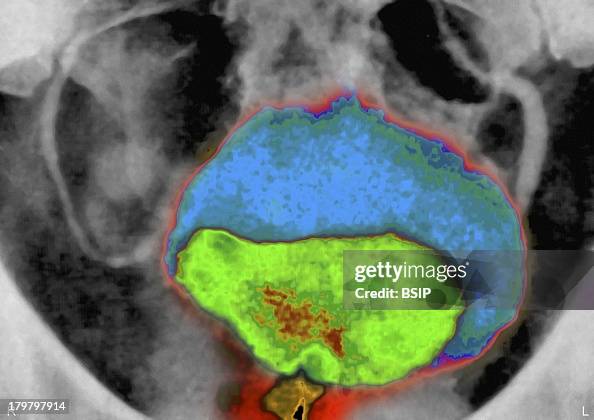 Prostatic Adenoma, X-Ray Prostatic Adenoma, X-Ray