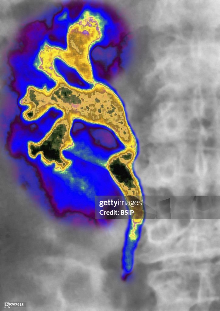 Lithiasis Ureteral Lithiasis, X-Ray, Hydronephrosis Or Nephritic Colic,... News ...