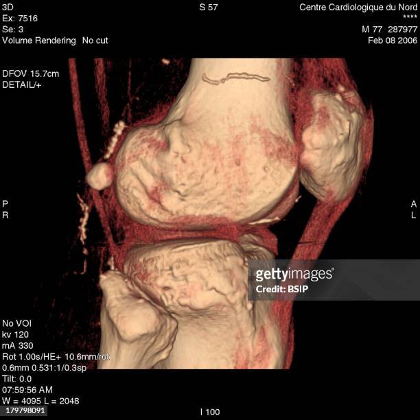 Knee, 3D Scan, Gonarthrosis Checkup, Scanner 3D, Sagittal View, Intermediary Thresholding For Visualization Of The Bone, The Tendons And The...