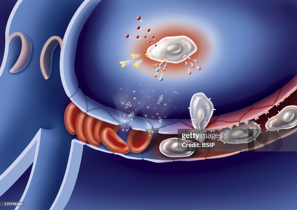 Venous Insufficiency
