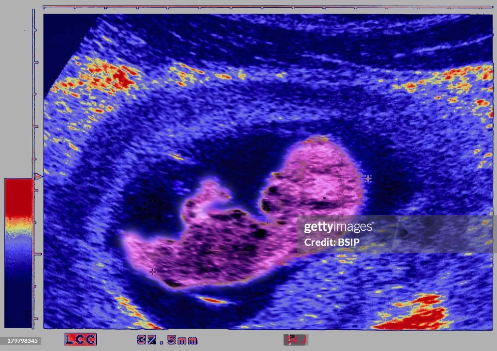 Ultrasound Biometry Of The Fetus