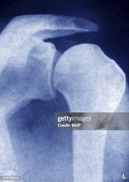 Dislocation Shoulder, X-Ray, Bone Lesion, Shoulder, Front View.