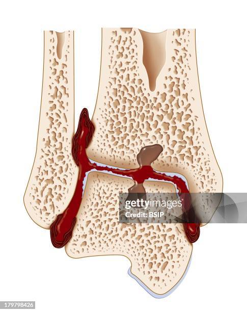 Hemophilic Arthopathy, Ankle, Frontal Section, Synovial Hypertrophy, Articular Effusion, Marginal Articular Effusion, Geodes, Destruction Of The...