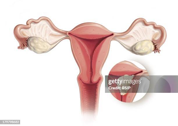 Cancer Endometrium, Drawing.