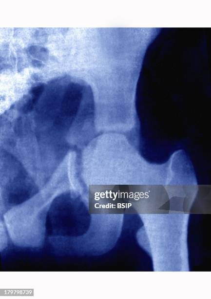 Fractured Hip, X-Ray, Fracture Of The Hip By Recess Of The Cotyle, Fracture Of The Iliac Bone Left Hip In Front View.