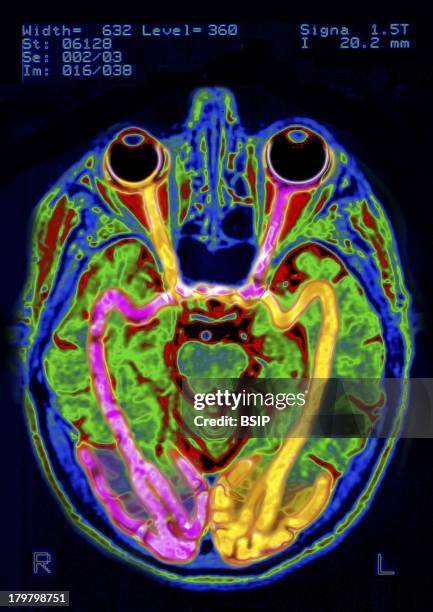 Brain, MRI.