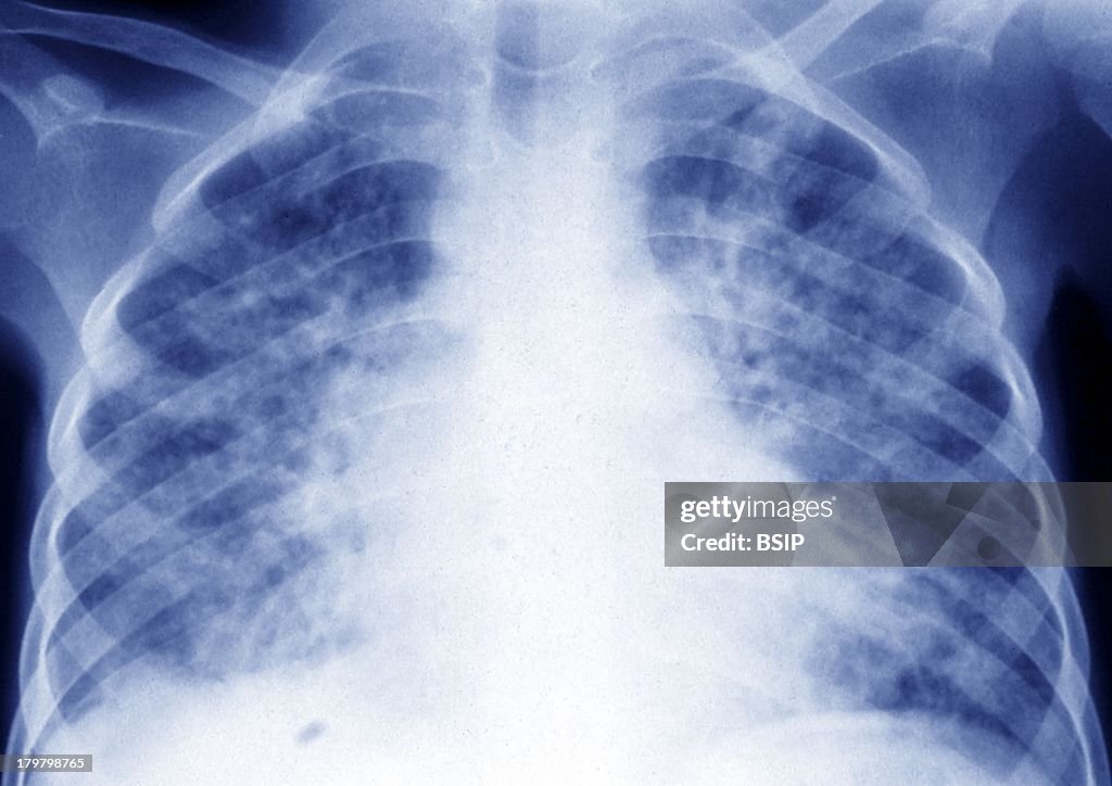 Pulmonary Tuberculosis, X-Ray