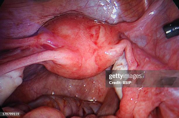 Lyon Hospital, Department of urology. Sex reassignment surgery, transgender Female to Male, hystero-ovariectomy under laparoscopy. Operation which...