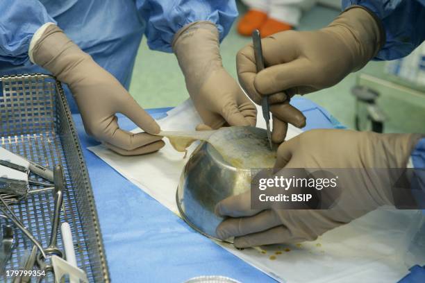 Rouen hospital, Plastic surgery, Skin grafting on the thorax of a man, the transplant is taken from the thigh of the patient.