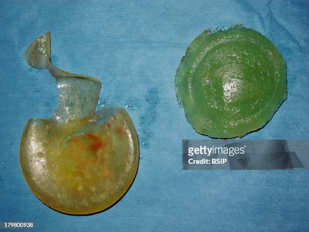 Breast Prosthesis, PIP breast implant.