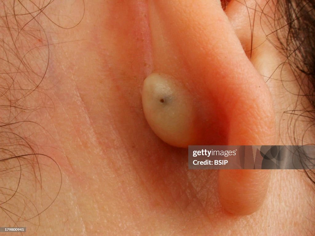 Sebaceous Cyst