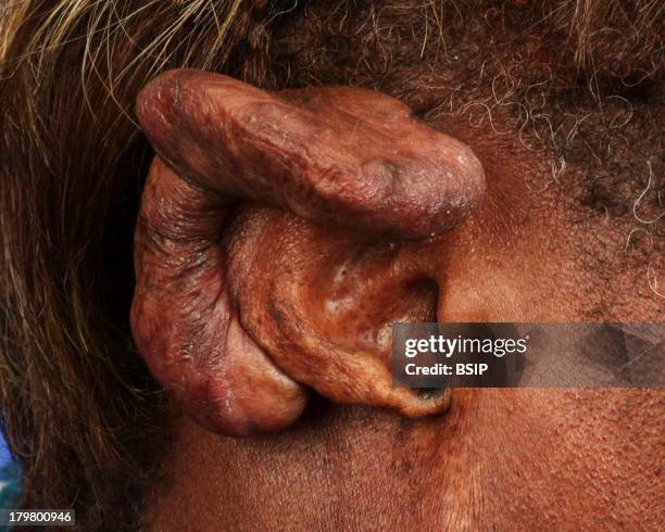 Keloid, Ear piercing keloid.