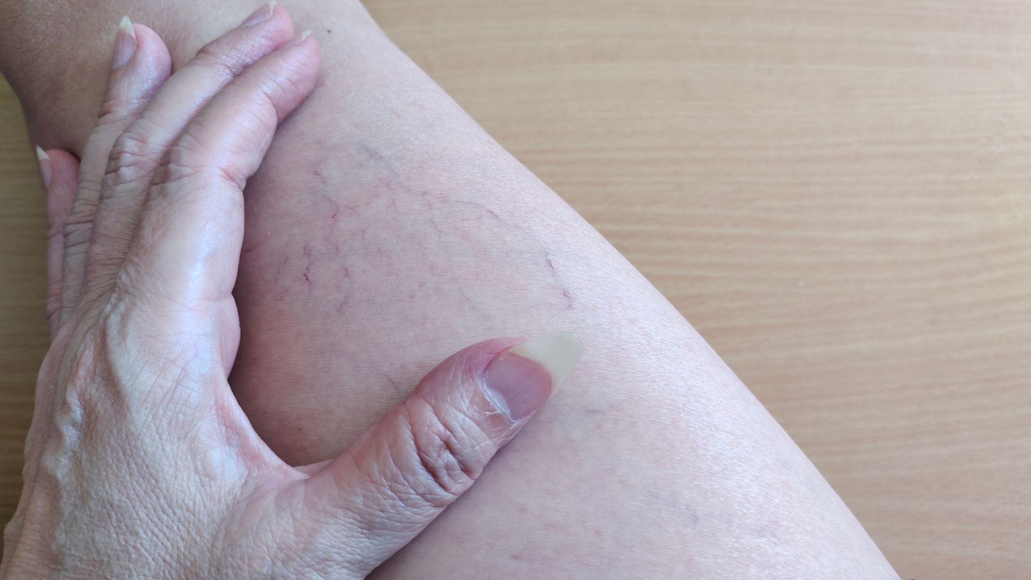 The varicose veins, blood spider. The varicose veins, blood spider.