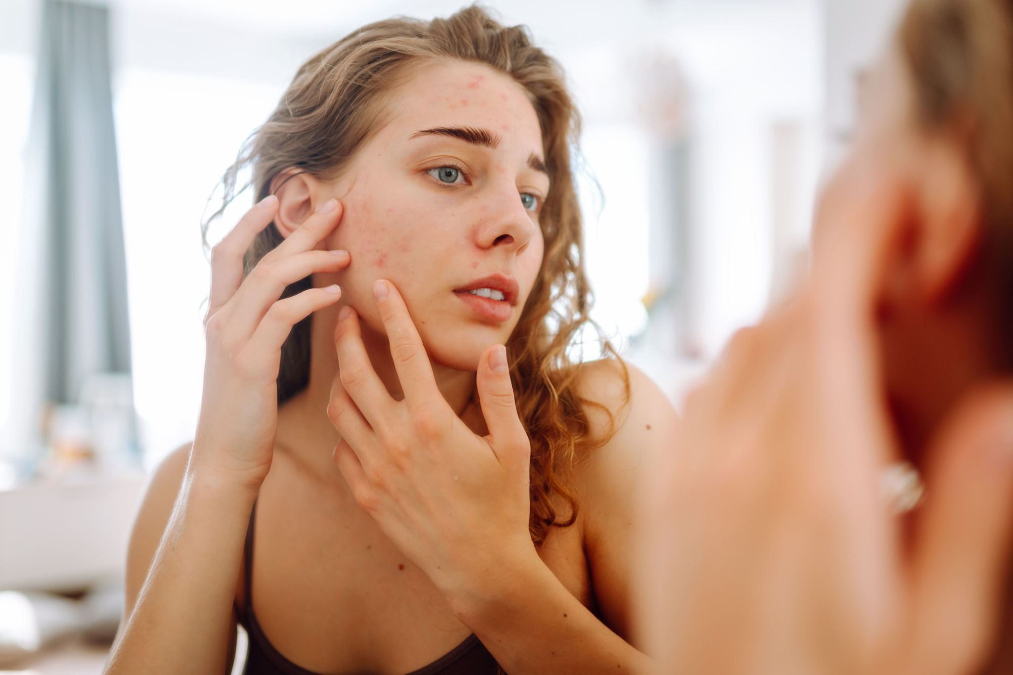 acne medication