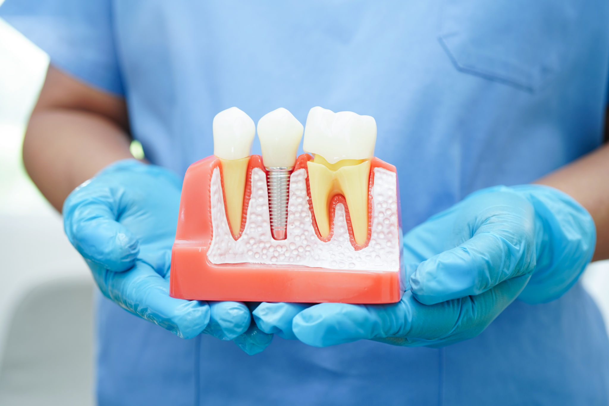 El médico sostiene el implante dental, las raíces de los dientes artificiales en la mandíbula, el conducto radicular del tratamiento dental, la enfermedad de las encías, el modelo de dientes para el dentista que estudia sobre odontología. El médico sostiene el implante dental, las raíces de los dientes artificiales en la mandíbula, el conducto radicular del tratamiento dental, la enfermedad de las encías, el modelo de dientes para el dentista que estudia sobre odontología.