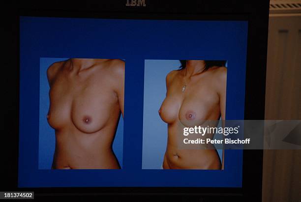 Vorher-Nacher Foto einer Patienten, Brust-OP von J A N I N E W I L C K E, Kaiserberg Klinik, Duisburg, Nordrhein-Westfalen, Deutschland, Europa,...