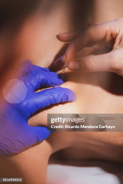 focused dry needling therapy - dry needling stock pictures, royalty-free photos & images