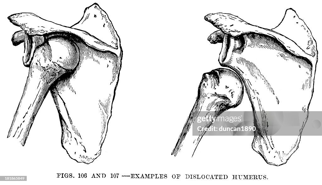 Humurus Dislocation Dislocated Humerus High-Res Vector Graphic - Getty Images