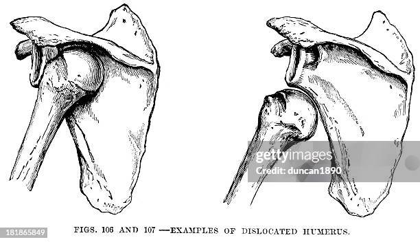 Humurus Dislocation Shoulder Dislocation Photos and Premium High Res Pictures - Getty Images
