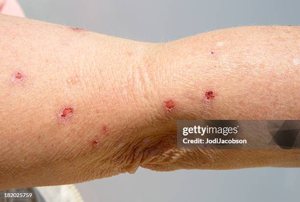 medical: vesicular dermatitis, sun and a perscription drug reaction - sun blistered stock pictures, royalty-free photos & images