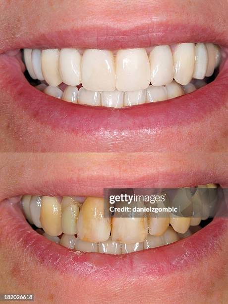 prima & dopo il sorriso design - sbiancamento dentale foto e immagini stock
