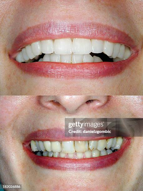before & after smile design - voor en na stockfoto's en -beelden