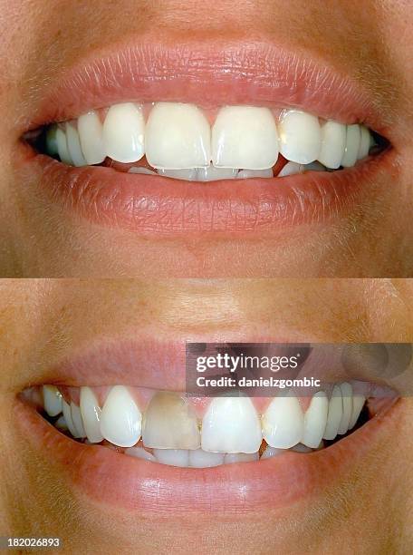 before & after smile design - voor en na stockfoto's en -beelden