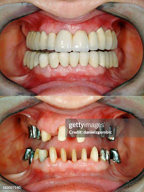 vor & nach vollständige dental wiederaufbau - dentalimplantat stock-fotos und bilder