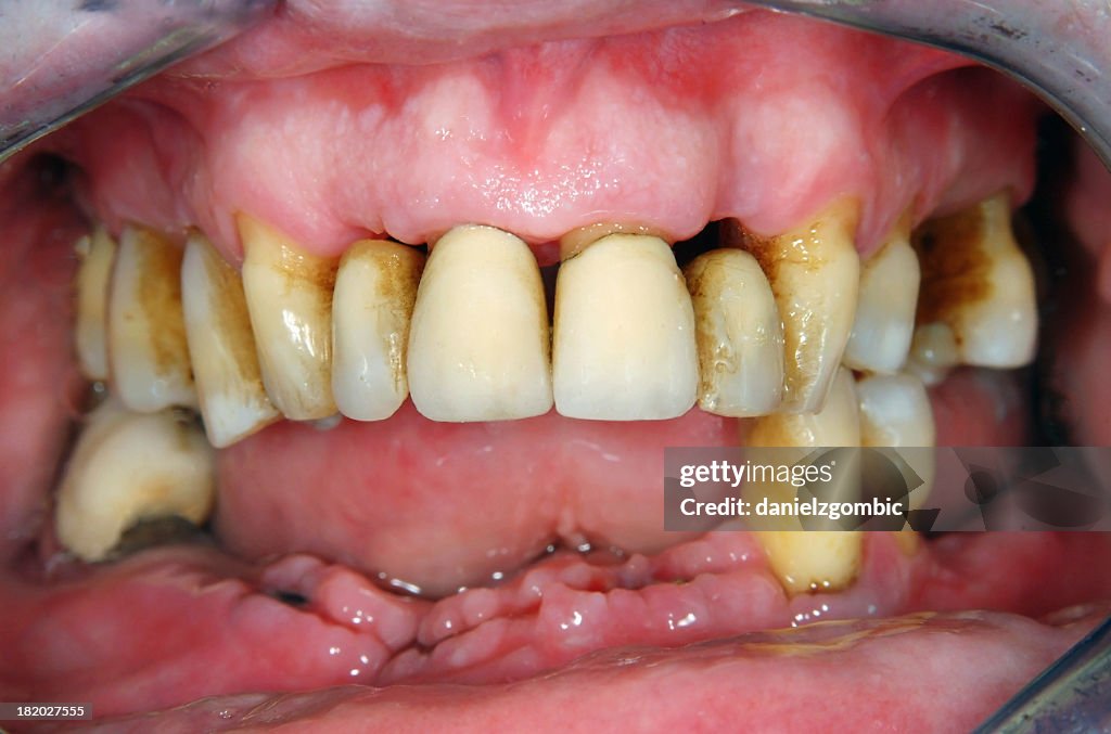 Periodontitis