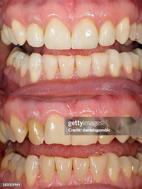 before & after smile design - before and after stock pictures, royalty-free photos & images