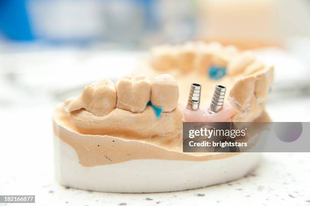 implante dentário modelo - equipamento protético imagens e fotografias de stock