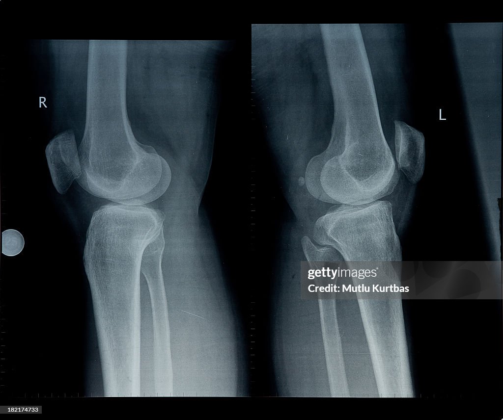 X-ray