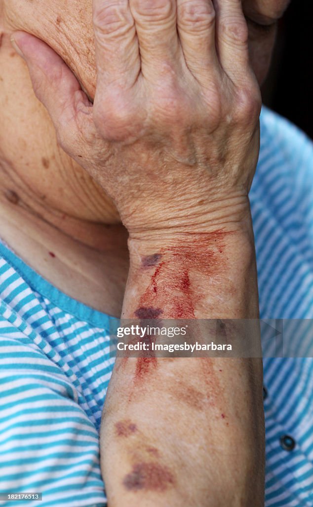 An old man with blood stain on his left arm