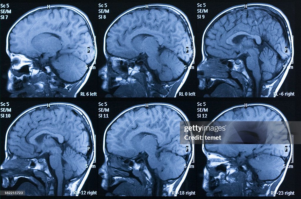 MRI scan of brain
