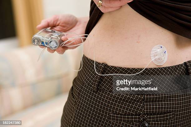 insulin infusion site - insulin pump stock pictures, royalty-free photos & images