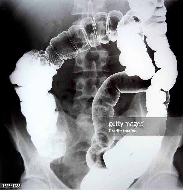 gastroenterology - abdomen xray stock pictures, royalty-free photos & images