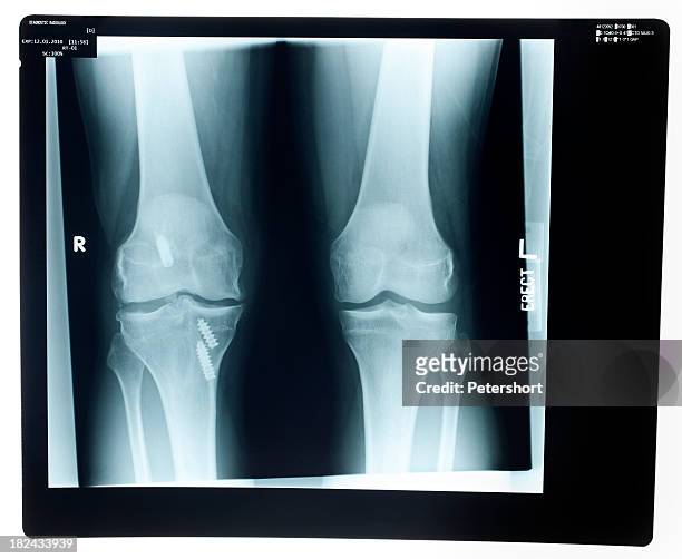 x-ray of die knie - knee surgery stock-fotos und bilder