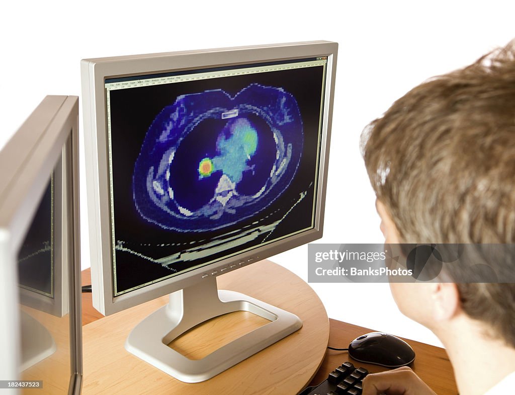 Radiologist Reviews a PET/CT Image Showing Lung Cancer
