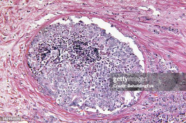 prostata adenocarcinoma - struttura cellulare foto e immagini stock
