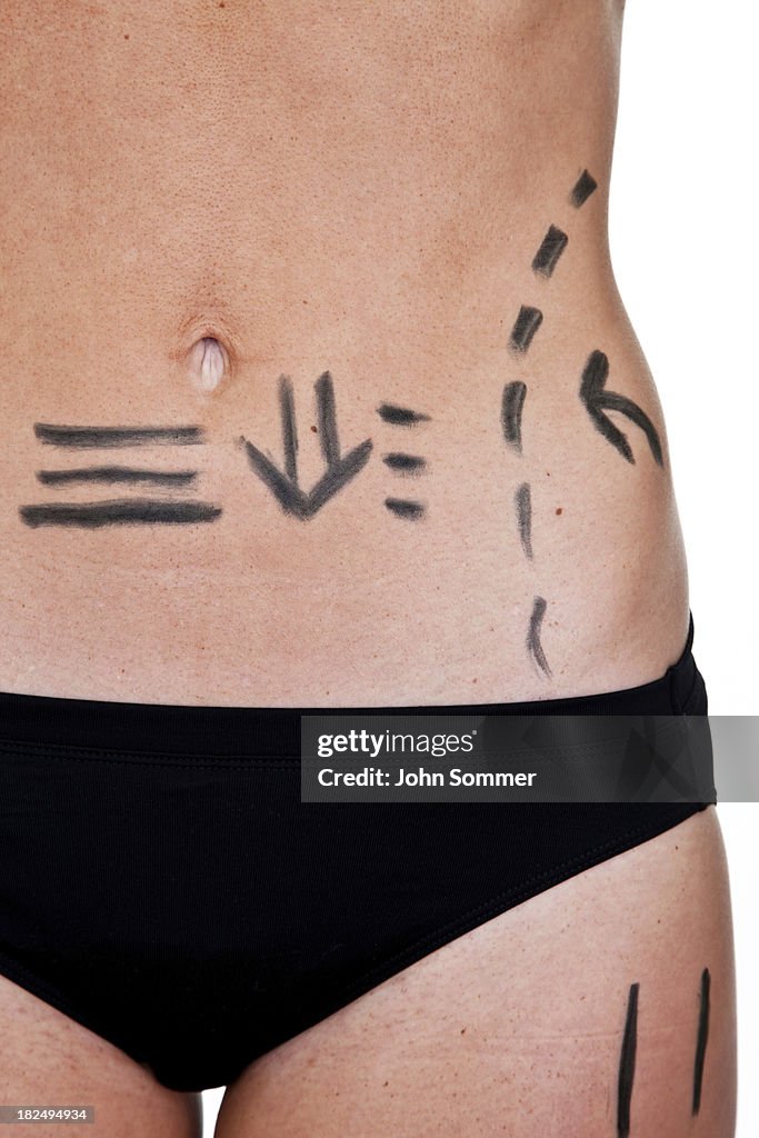 Woman with marked outline for cosmetic surgery