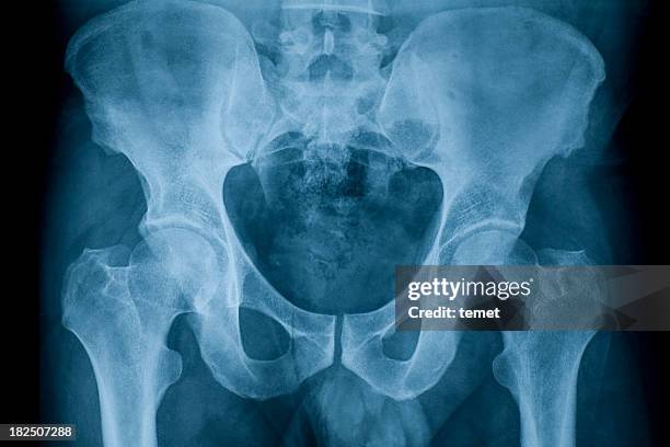 pelvis - röntgen stockfoto's en -beelden