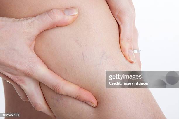 varicose vien on leg. - varicose vein stock pictures, royalty-free photos & images