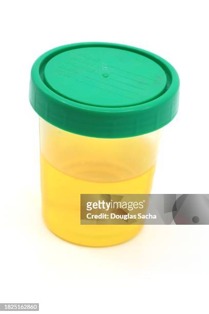 urine sample in a clinical specimen container - a container for urine stock-fotos und bilder