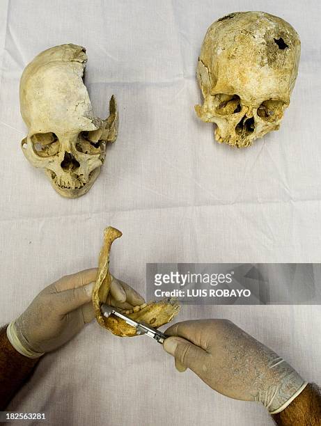 An archaeologist measures a dental piece that belonged to a pre-Hispanic indigenous man at the Pre-Hispanic Ossuarty in Cali, Colombia, on September...