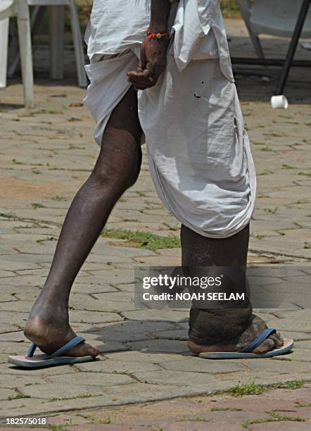 An elderly Indian Lambadi tribal man, suffering with elephantiasis, participate in an event for International Day of Older Persons in Hyderabad on...