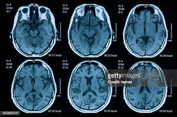 brain - medical scan 個照片及圖片檔