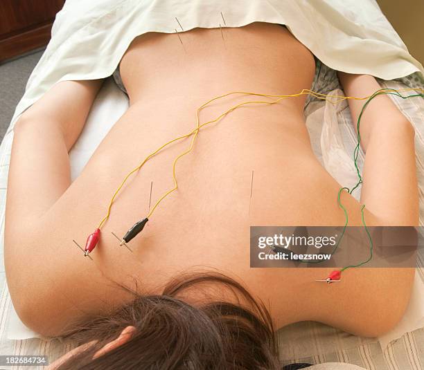 patient receiing electrical stimulation acupuntcure treatment - electrode stock pictures, royalty-free photos & images