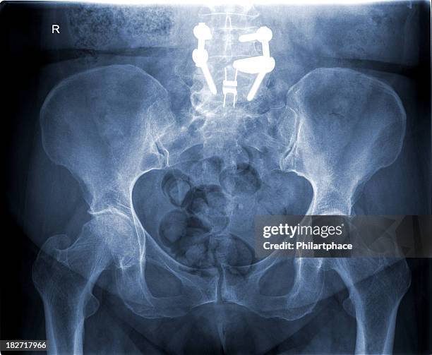 imagem de raios x mulher pélvis - pélvis imagens e fotografias de stock