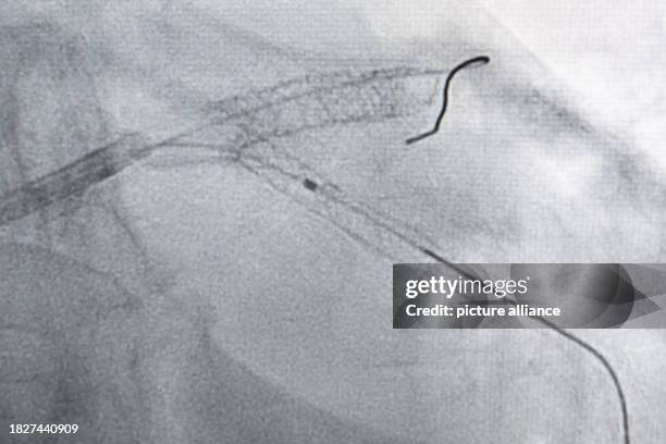 November 2023, Baden-Württemberg, Stuttgart: The placement of a stent can be seen on an X-ray image during heart surgery. Photo: Marijan Murat/dpa