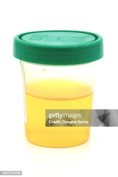 urine sample in a bio-hazard specimen container - urine stockfoto's en -beelden